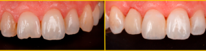 Caso clínico con composites: antes y después