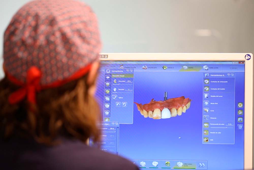 Tecnología cerec para carillas dentales en Clínica Pla