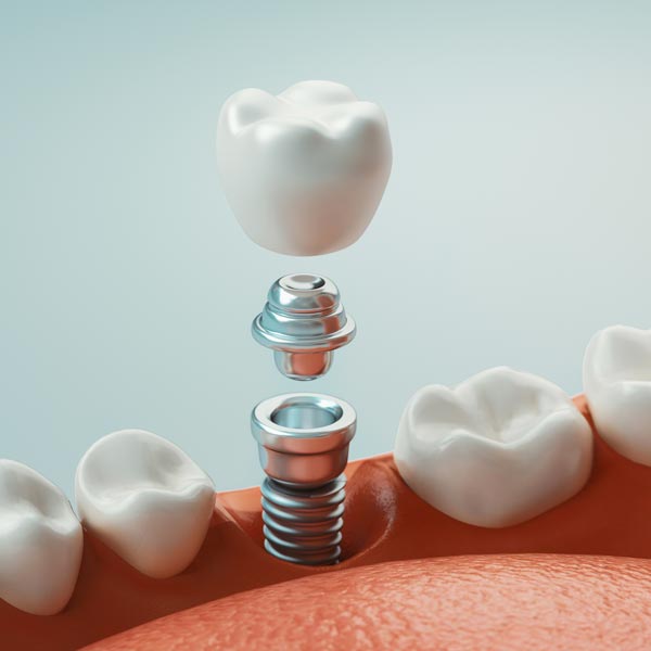 Implantes dentales en Albacete