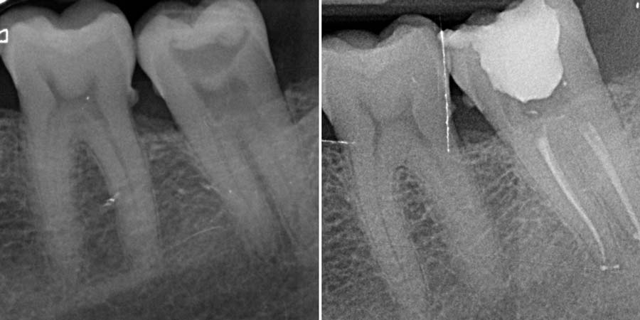 Radiografía de una endodoncia, antes y después