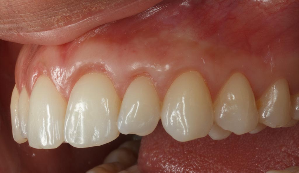 Injerto De Encía Es Muy Doloroso Caso Real de Injerto de Encía - Antes/Después | Pla Dental