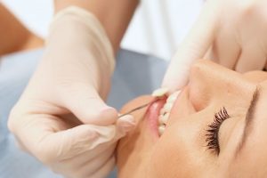 Tonos de blanqueamiento dental