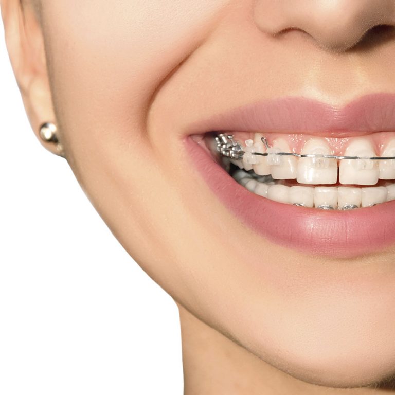 Ventajas brackets transparentes Clínica Dental Rafael Pla