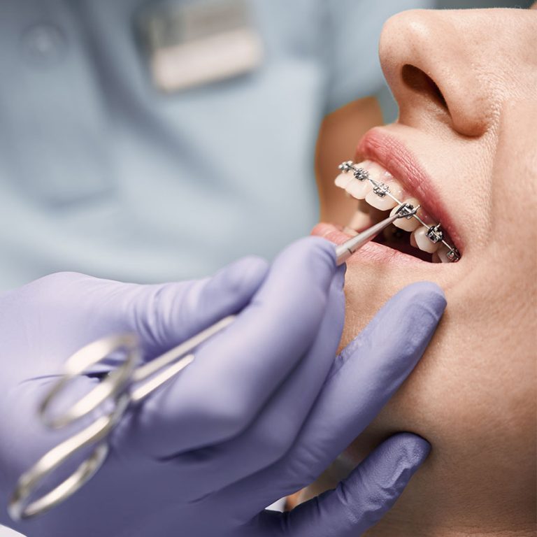 Ortodoncia con brackets metálicos Clínica Dental Rafael Pla