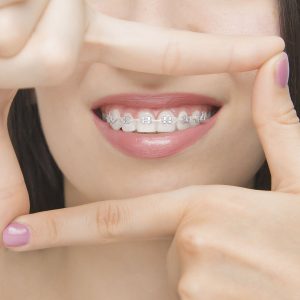 Ortodoncia con brackets metálicos