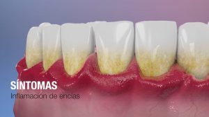 Encías inflamadas