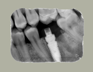 Implante dental