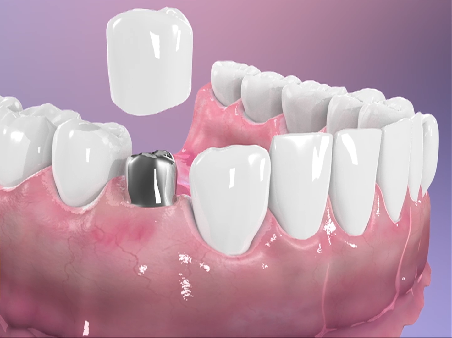 implante dental