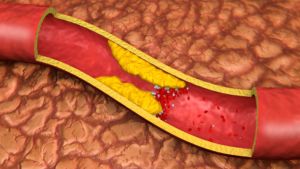 Plasma rico en factores de crecimiento