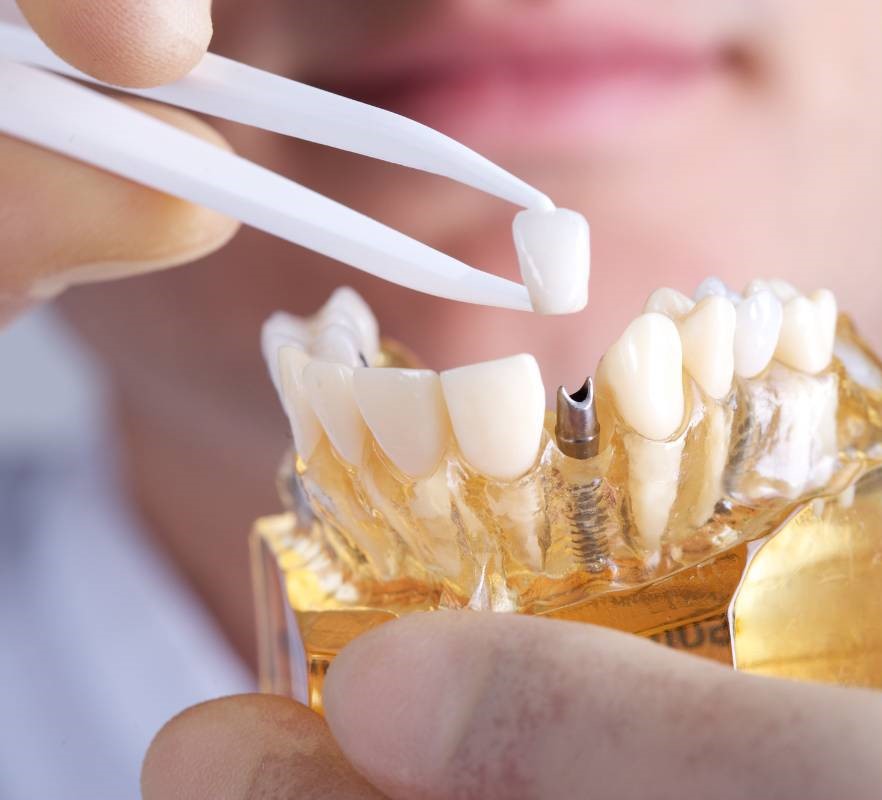 Implante dental