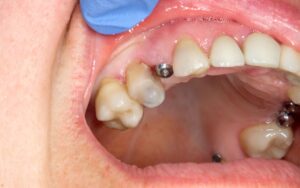 Implante dental