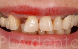 ausencias y desgastes dentales
