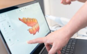 Implantes dentales