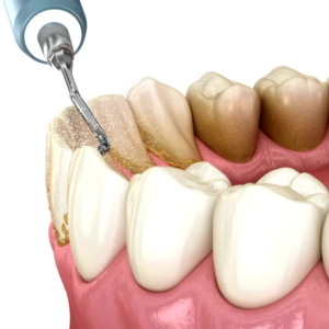 Eliminar el sarro dental en la dentista