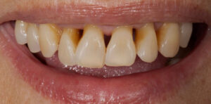 Caso clínico enfermedad periodontal