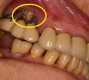 Caso clínico paciente con osteonecrosis