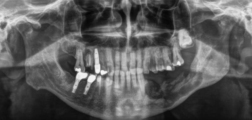 Radiografía de una ostenecrosis mandibular