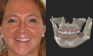 Diseño de sonrisa digital