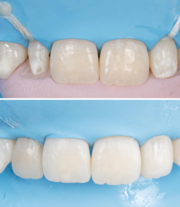 Antes y después tratamiento mínimamente invasivo de carillas dentales
