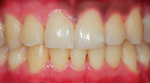 Melanosis gingival