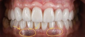 melanosis gingigival encías negras