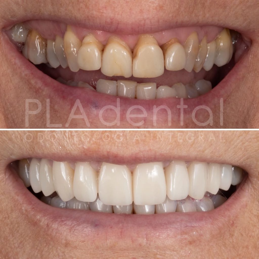 Antes y después de tratamiento interdisciplinar con Invisalign, carillas y blanqueamiento en Clínica Dental Rafael Pla en Albacete