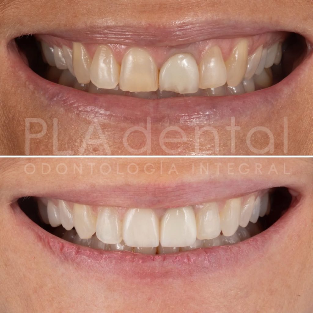 Caso clínico de Invisalign en Albacete con alineadores, alargamiento coronario y restauración estética en Clínica Dental Rafael Pla