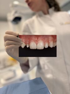 Problemas del desarrollo, dientes conoides