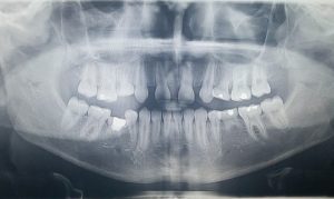 Agenesia dental