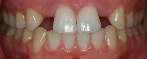 Agenesia dental